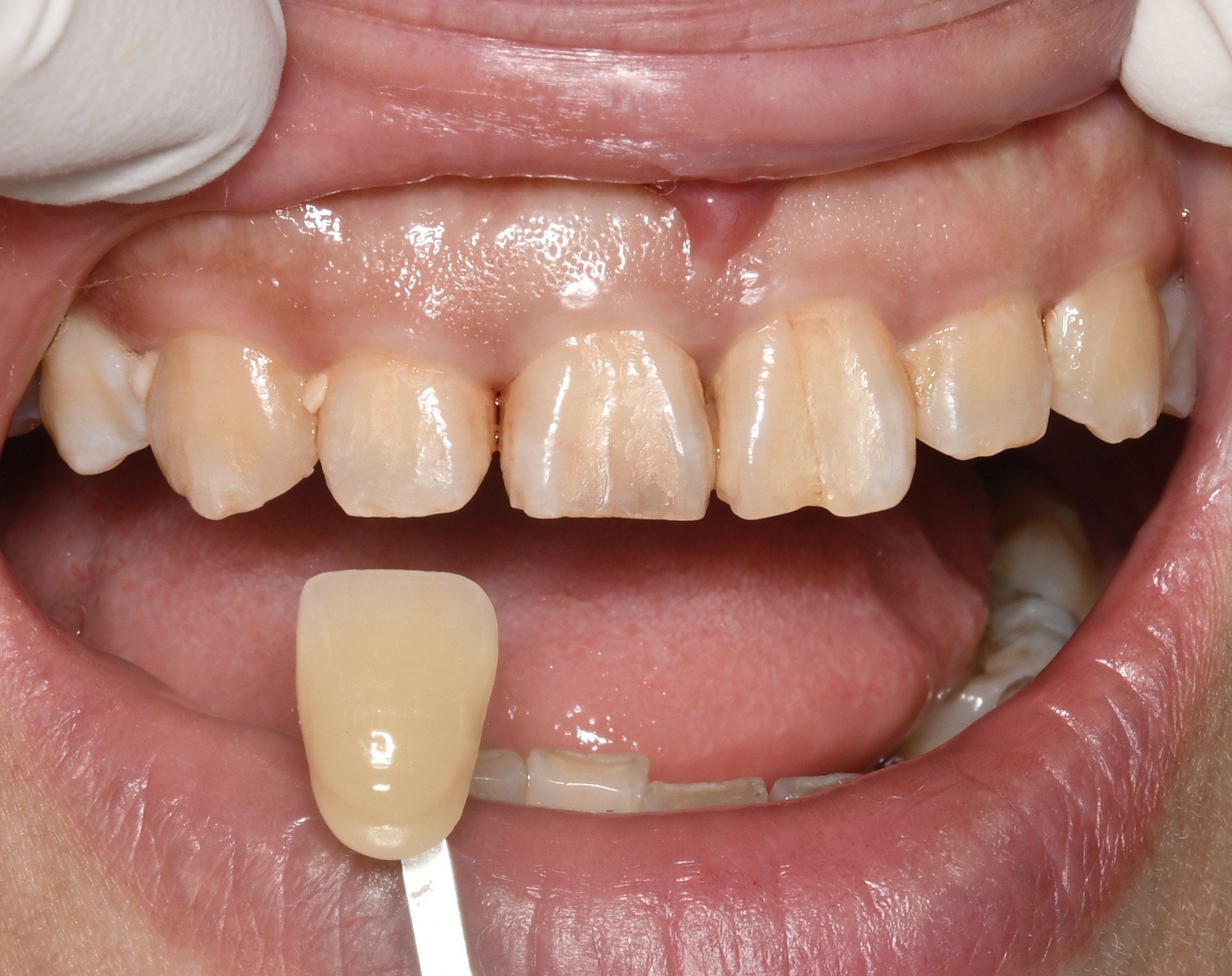 啃骨头把牙齿啃裂了