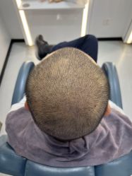 -大麦微针植发全国连锁