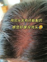 体验后-北京雍禾植发医院