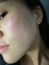 -爱莎扁平疣·汗管瘤·斑痣中心