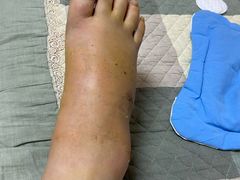 -大韩庄韩氏祖传正骨