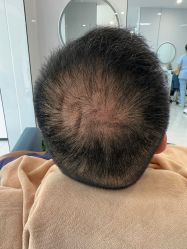 -大麦微针植发丨全国连锁
