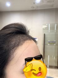 -大麦微针植发全国连锁