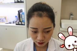 点击看大图 -大麦微针植发丨全国连锁