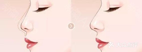 塌鼻子如何变立体？【案例详解】
