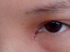 第八天-上海华安整形外科门诊部