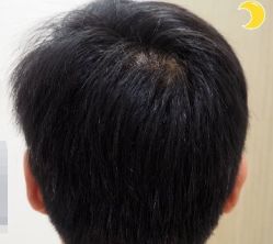 -大麦微针植发丨全国连锁