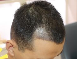 -大麦微针植发丨全国连锁