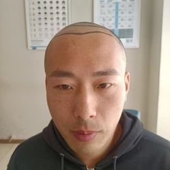 -大麦微针植发丨全国连锁