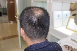 -大麦微针植发丨全国连锁