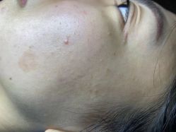 体验前-爱莎扁平疣·汗管瘤·斑痣中心