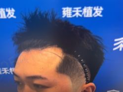 -雍禾植发全国连锁