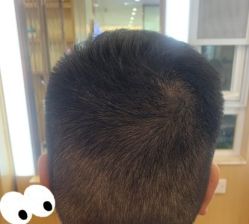 -大麦微针植发丨全国连锁