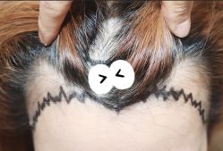 -大麦微针植发全国连锁