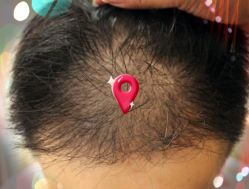 -大麦微针植发全国连锁