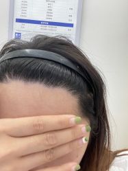 -大麦微针植发丨全国连锁