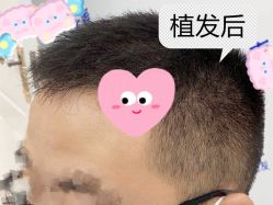 -大麦微针植发全国连锁