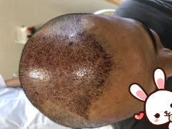 点击看大图 -大麦微针植发丨全国连锁