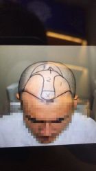 -大麦微针植发全国连锁