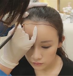 -碧莲盛·不剃发植发