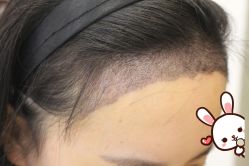 -大麦微针植发丨全国连锁