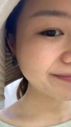 体验后-深圳美莱医疗美容医院