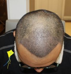 -大麦微针植发丨全国连锁