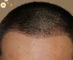 -大麦微针植发丨全国连锁