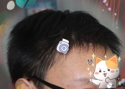 -大麦微针植发全国连锁