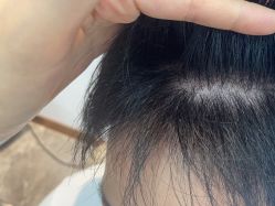 -碧莲盛·不剃发植发