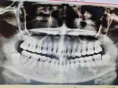 -赫尔森口腔·牙齿种植修复