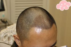 -大麦微针植发丨全国连锁