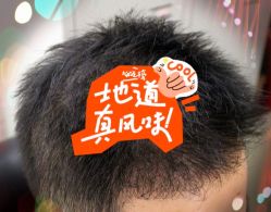 -大麦微针植发全国连锁