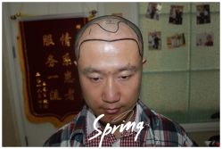 -大麦微针植发全国连锁