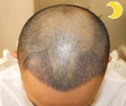 -大麦微针植发丨全国连锁