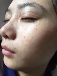 -美丽人生祛斑扁平疣汗管瘤中心