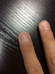-EPAI·灰指甲·甲沟炎·嵌甲护理