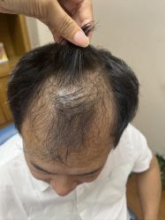 -大麦微针植发全国连锁