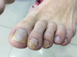 -德哥灰指甲脚气甲沟炎跖疣护理