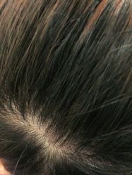 体验后-大麦微针植发全国连锁