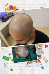 -大麦微针植发全国连锁