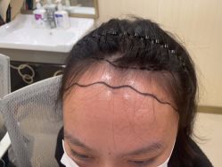 点击看大图 -碧莲盛·不剃发植发
