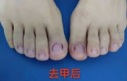 -德哥灰指甲脚气甲沟炎跖疣护理