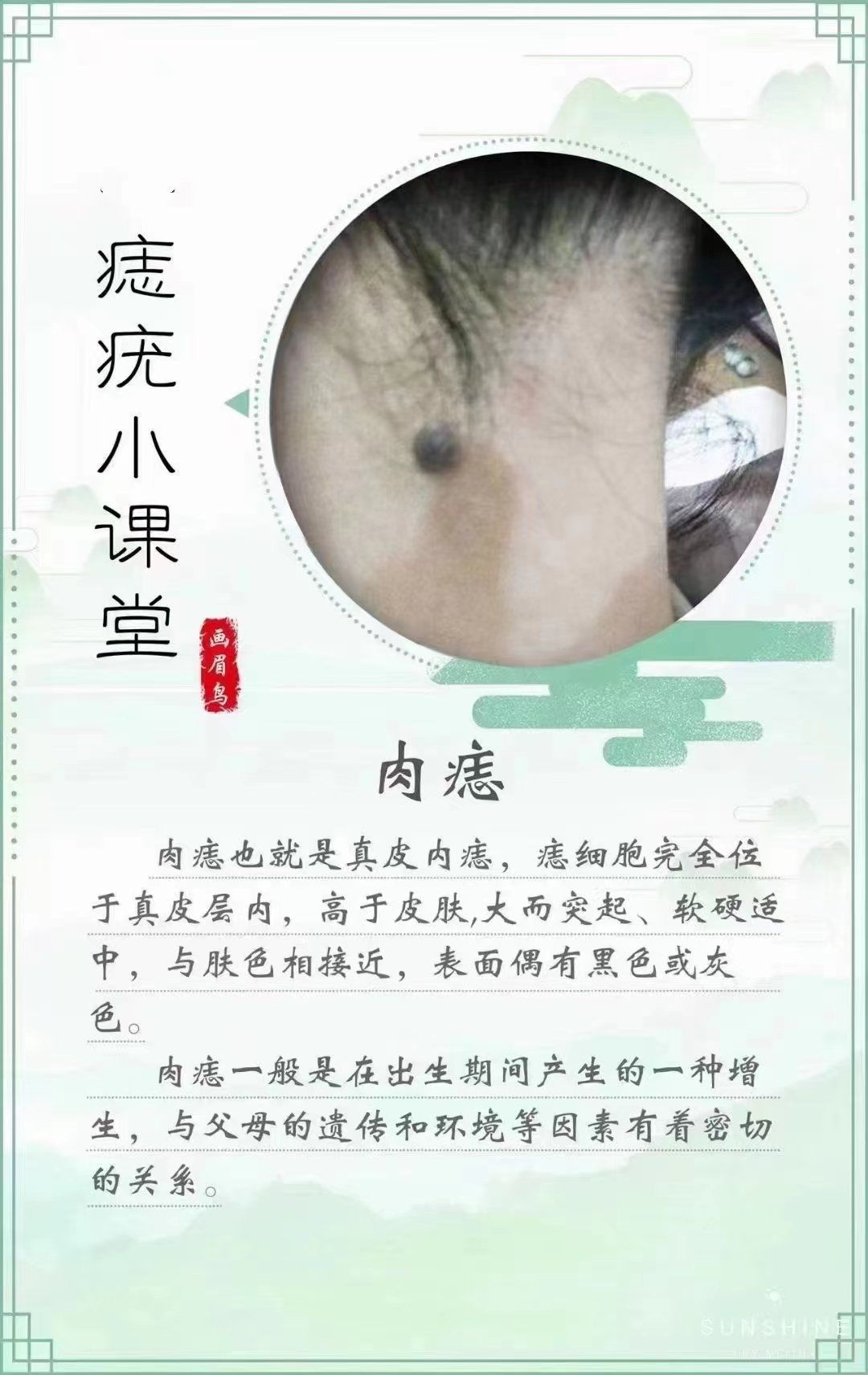 肉痣
肉痣也就是真皮内痣,痣细胞完全