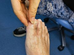 -祖传修脚甲沟炎灰指甲鸡眼