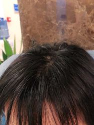 -碧莲盛·不剃发植发