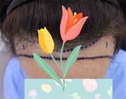 点击看大图 -大麦微针植发全国连锁
