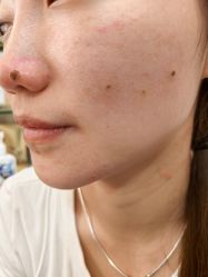 -北京美痣堂古方祛痣斑疣瘊