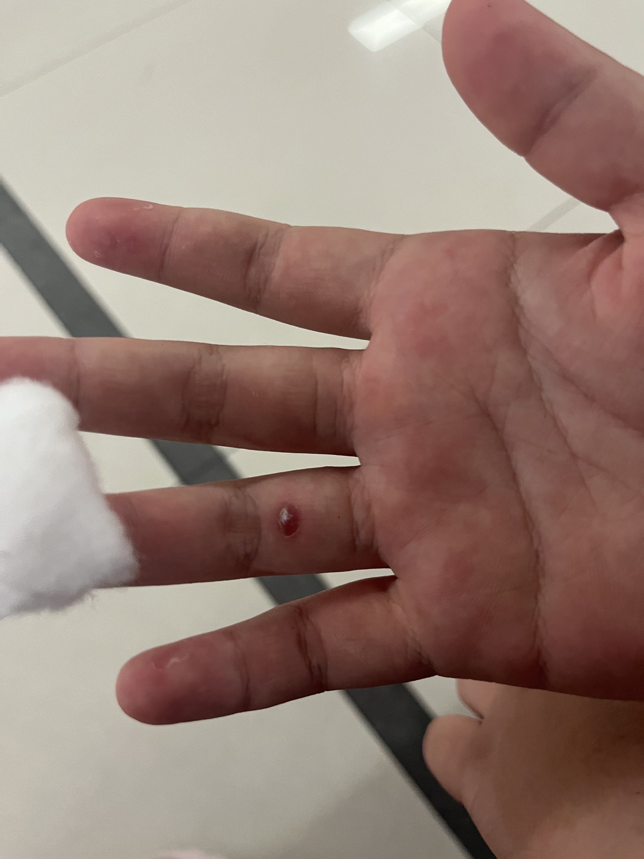 玩个攀岩小朋友手伤了