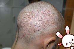 -大麦微针植发丨全国连锁